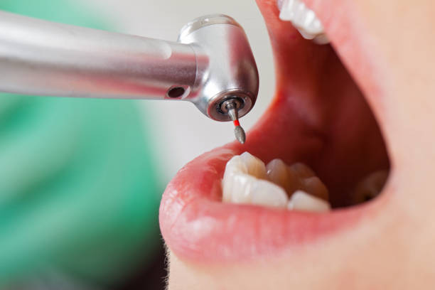 Best Broken or Chipped Tooth Repair in Trinidad, CO